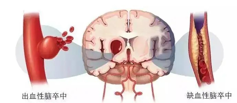 守护脑健康｜卒中解决方案