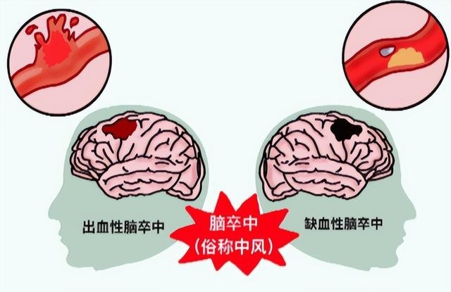 健康宣传丨别让卒中得逞，5G移动卒中单元时刻待命！